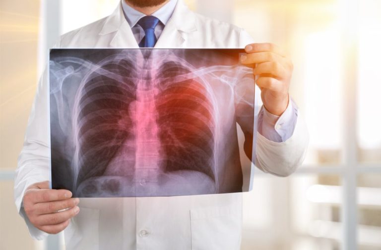 Atezolizumab, A Drug For Immunotherapy, Can Treat The Early Stages Of Lung Cancer