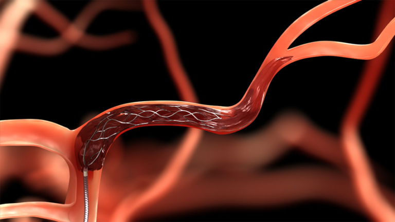 Clot Retrieval Can Have Adverse Impacts On Stroke Patients